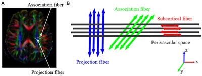 Dysfunction of the glymphatic system in childhood absence epilepsy